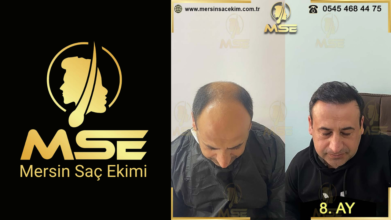 MERSİN SAÇ EKİMİ